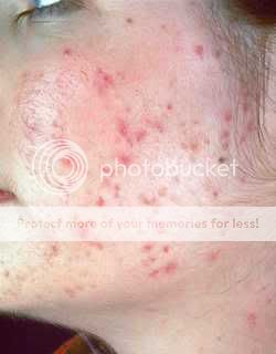 Prezzo di medicina di psoriasi