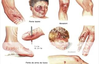 Togliere un asterisco vascolare su una faccia Mosca